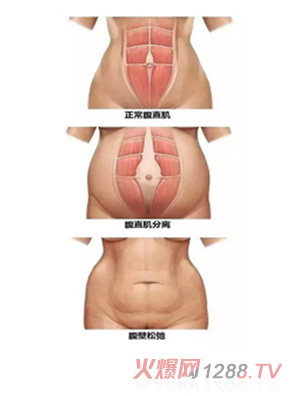 少林永化堂產(chǎn)后項目-腹直肌修復(fù)