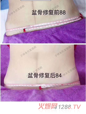 少林永化堂產(chǎn)后項目-骨盆修復(fù)